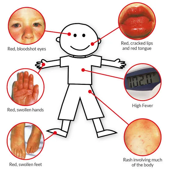 अमेरिका और यूरोपीय देशों में कई बच्चों की जान ले चुकी कावासाकी बीमारी (Kawasaki Disease) के लक्षण चेन्नई के एक आठ साल के बच्चे में मिले हैं।