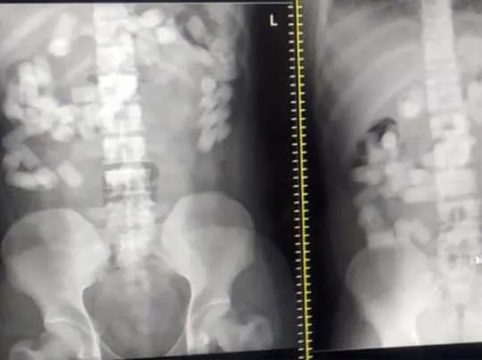 करोड़ों की ड्रग्स पेट में छिपाकर ला रहा विदेशी मुंबई एयरपोर्ट से गिरफ्तार