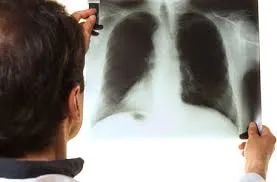 भारत में टीबी के मरीजों की संख्या अन्य देशों की तुलना में काफी अधिक...