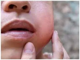 ठाणेकर त्रस्त मौसम की मार गाल फूली रोग से ... विशेषज्ञों की राय, मुख करें साफ; घर पर करें आराम