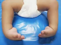 क्लब फुट का होता है राजावाडी सरकारी अस्पताल में मुफ्त इलाज... 19 महीने में 84 बच्चों के पैर हुए ठीक