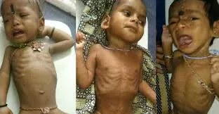 ओडिशा : सुंदरगढ़ में 3,633 से ज़्यादा कुपोषित बच्चे 