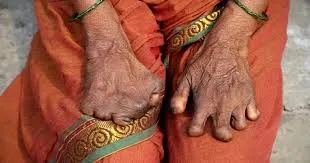 मुंबई : कुष्ठ रोग को एक अधिसूचित रोग घोषित; दो सप्ताह के भीतर मामले की सूचना स्वास्थ्य कार्यालयों को देना अनिवार्य