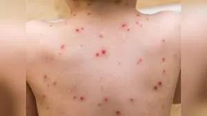 मुंबई : ठंड के दिनों में भी चिकनपॉक्स का प्रकोप