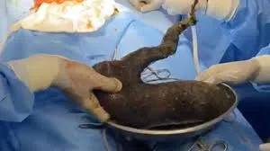 मुंबई : 12 साल की बच्ची के पेट से निकला एक किलो बालों का गुच्छा, चार साल से बाल खाने की थी आदत