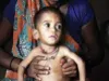 ठाणे में 1,000 से अधिक बच्चे कुपोषण का शिकार, जिले में 'कुपोषण मुक्तिसाथी दत्तक-पालक अभियान' की हुई शुरुआत