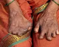 मुंबई : कुष्ठ रोग को एक अधिसूचित रोग घोषित; दो सप्ताह के भीतर मामले की सूचना स्वास्थ्य कार्यालयों को देना अनिवार्य