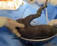 मुंबई : 12 साल की बच्ची के पेट से निकला एक किलो बालों का गुच्छा, चार साल से बाल खाने की थी आदत