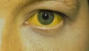 अकोला में दूषित पानी पीने से 30 महिला पुलिस ट्रेनी को हुआ पीलिया