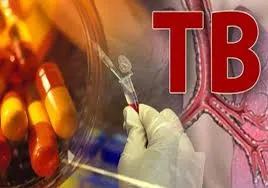 टीबी दवाओं की कमी... 3 महीने तक टीबी के मरीजों को नियमित दवाएं मिलना होगा मुश्किल !