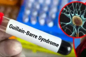 मुंबई: जीबीएस के 225 मामले सामने आए; 197 की पुष्टि हुई