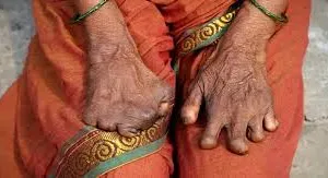 मुंबई : कुष्ठ रोग को एक अधिसूचित रोग घोषित; दो सप्ताह के भीतर मामले की सूचना स्वास्थ्य कार्यालयों को देना अनिवार्य